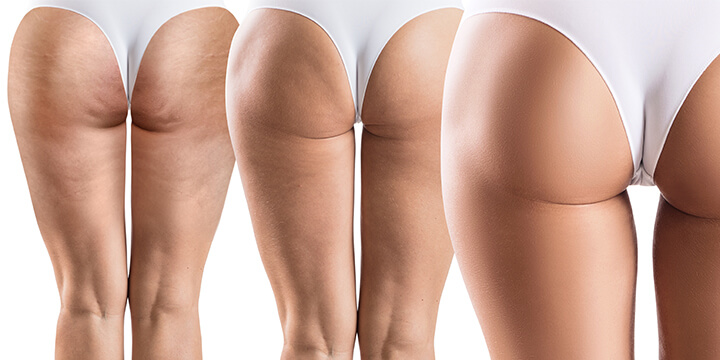 éliminer la cellulite